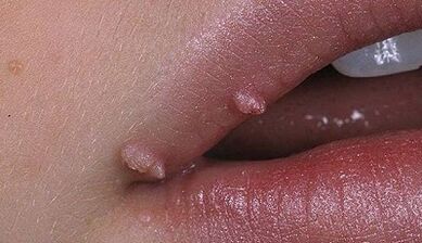 A papilloma típusai az emberekben