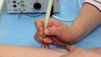 Hogyan lehet megszabadulni a test papillómáitól