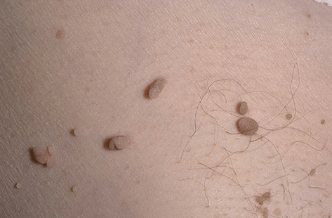 Papilloma