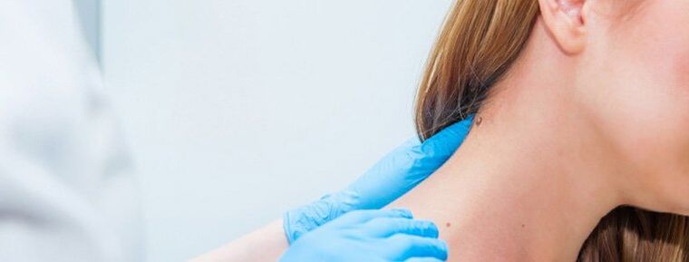 Papilloma a nyakán