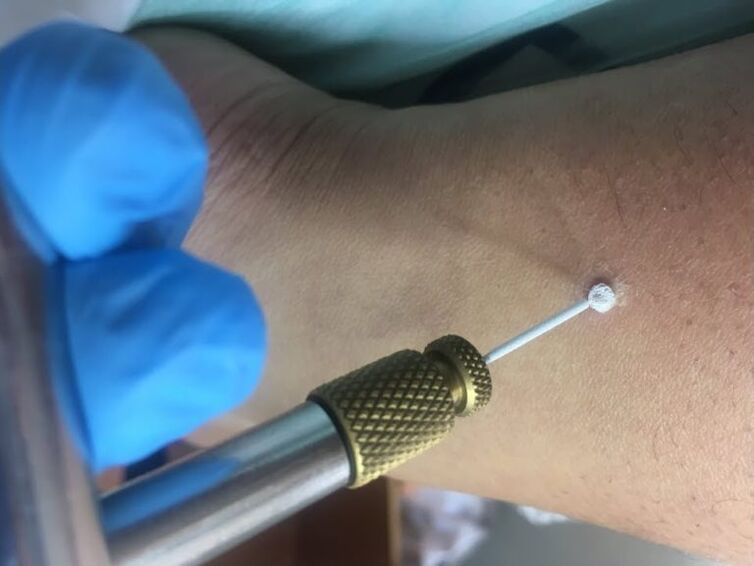 a szemölcsök eltávolításának módjai