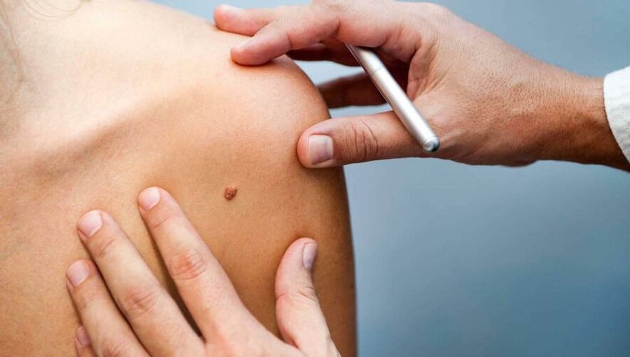 Bőrgyógyász papillómás beteget vizsgál