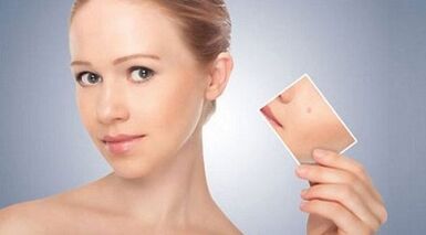 a szemölcsök és papillómák hatékony gyógymódjainak áttekintése