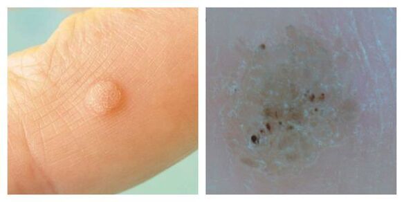 Rendes szemölcs a vizsgálat és a dermatoszkópia során